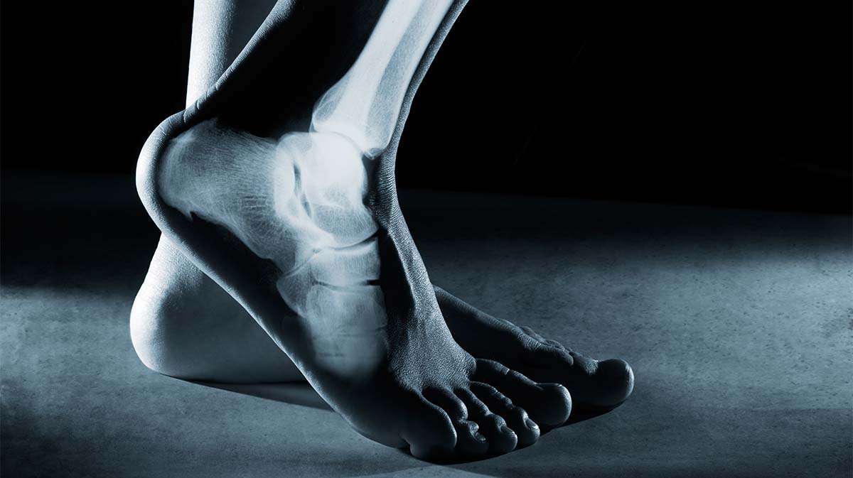 X-ray of a foot